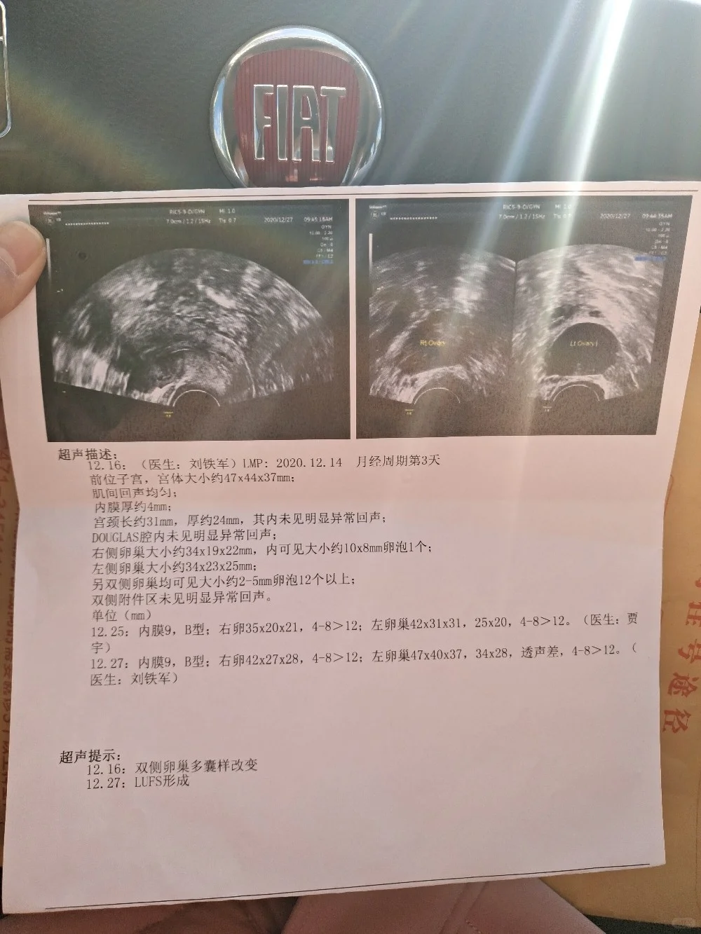 多囊卵巢综合征,哪家代孕机构靠谱-国内代生贵吗